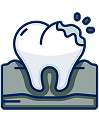 Affordable dental veneers